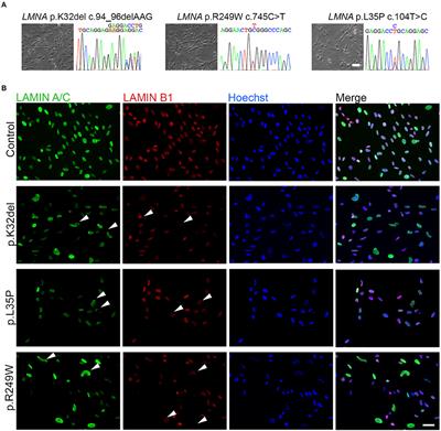 Modeling Skeletal Muscle Laminopathies Using Human Induced Pluripotent Stem Cells Carrying Pathogenic LMNA Mutations